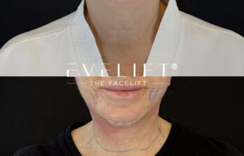 female patient before and after EVELIFT®
