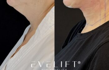 female patient before and after EVELIFT®
