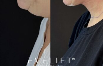 female patient before and after EVELIFT®