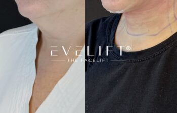 female patient before and after EVELIFT®