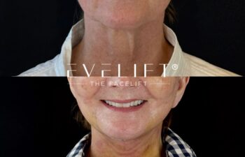 female patient before and after EVELIFT®