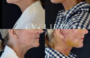 female patient before and after EVELIFT®