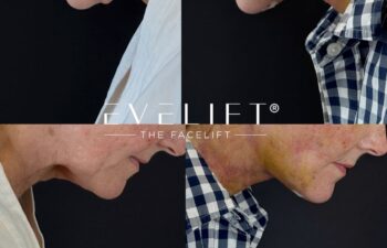 female patient before and after EVELIFT®