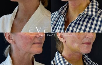 female patient before and after EVELIFT®