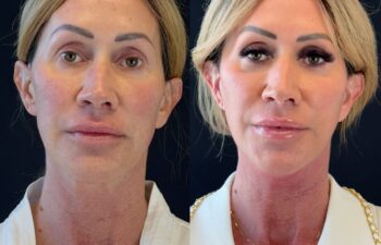 female patient before and after EVELIFT®