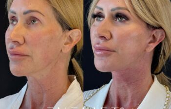 female patient before and after EVELIFT®