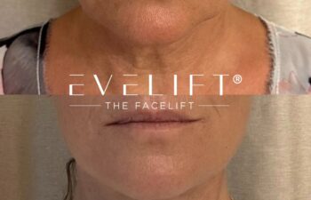 female patient before and after EVELIFT®