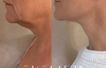 female patient before and after EVELIFT®