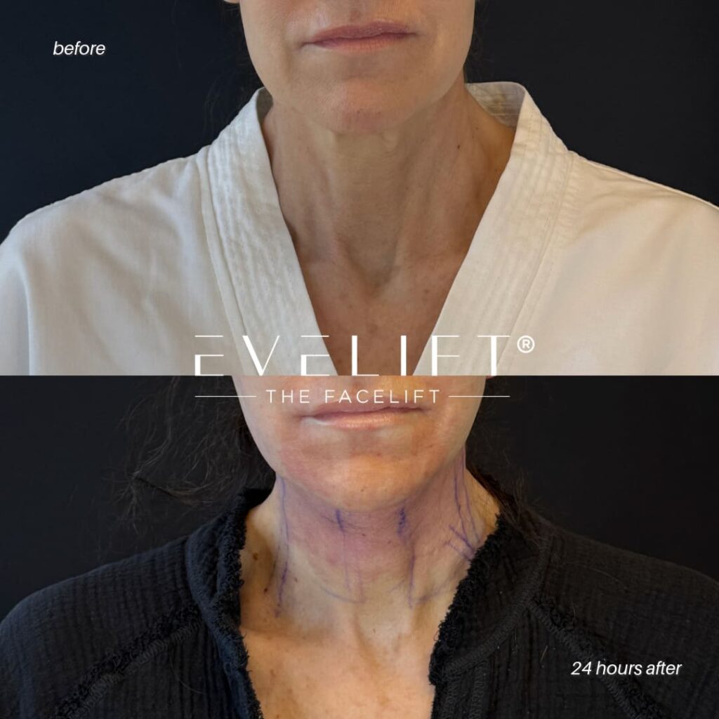 female patient before and after EVELIFT®