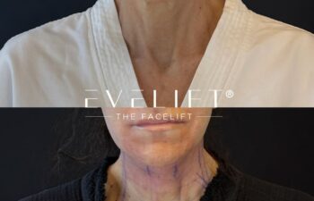 female patient before and after EVELIFT®