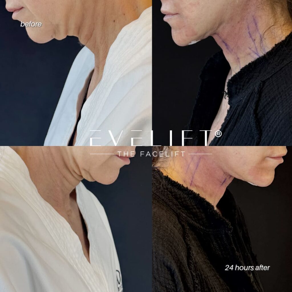 female patient before and after EVELIFT®