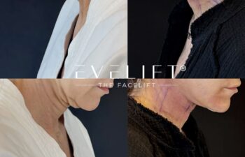 female patient before and after EVELIFT®