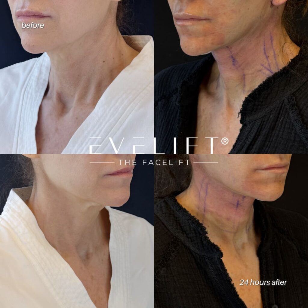 female patient before and after EVELIFT®