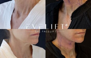 female patient before and after EVELIFT®
