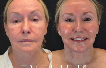 female patient before and after EVELIFT®