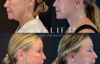 female patient before and after EVELIFT®