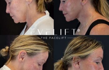 female patient before and after EVELIFT®