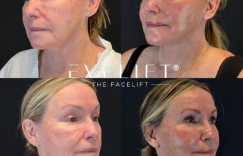 female patient before and after EVELIFT®