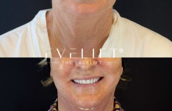 female patient before and after EVELIFT®