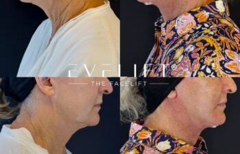 female patient before and after EVELIFT®