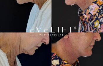 female patient before and after EVELIFT®