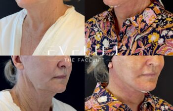 female patient before and after EVELIFT®