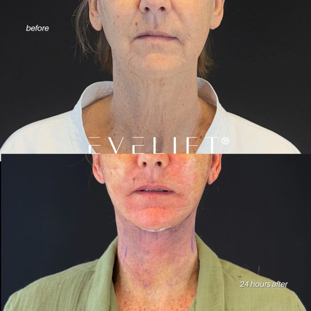 female patient before and after EVELIFT®