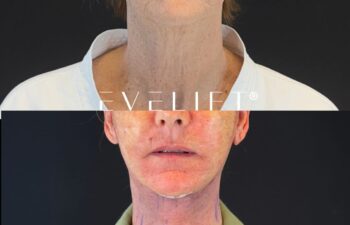 female patient before and after EVELIFT®