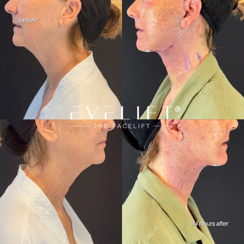 female patient before and after EVELIFT®