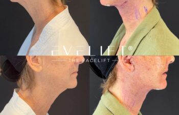 female patient before and after EVELIFT®