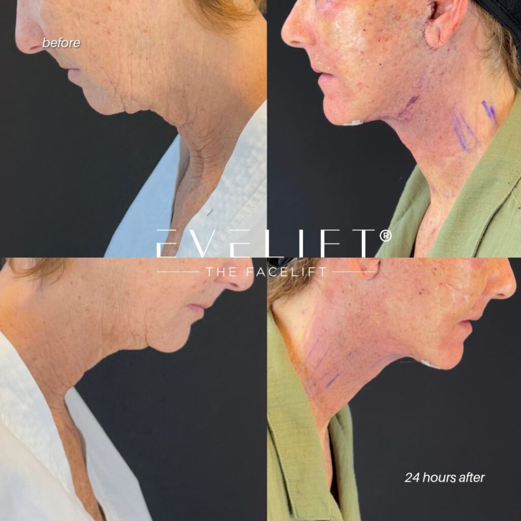 female patient before and after EVELIFT®