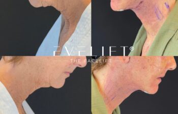 female patient before and after EVELIFT®