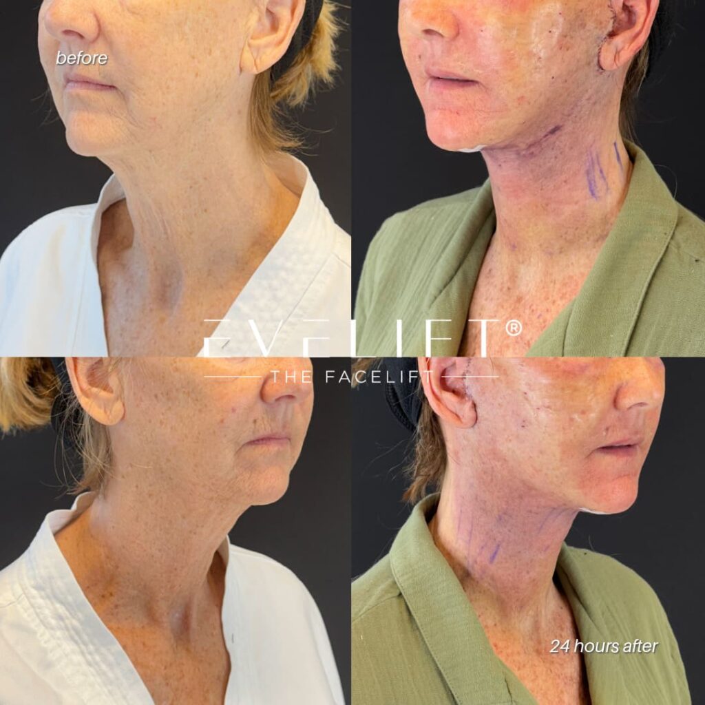 female patient before and after EVELIFT®