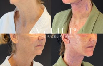 female patient before and after EVELIFT®