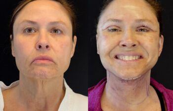 female patient before and after EVELIFT®