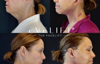 female patient before and after EVELIFT®