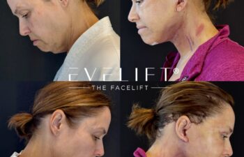 female patient before and after EVELIFT®