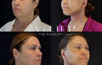 female patient before and after EVELIFT®