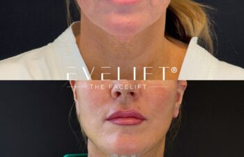 female patient before and after EVELIFT®