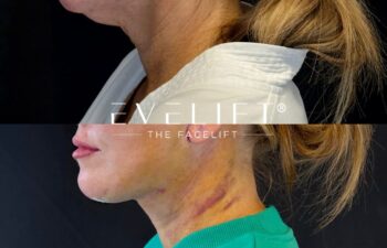 female patient before and after EVELIFT®