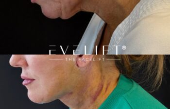 female patient before and after EVELIFT®