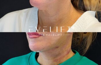 female patient before and after EVELIFT®