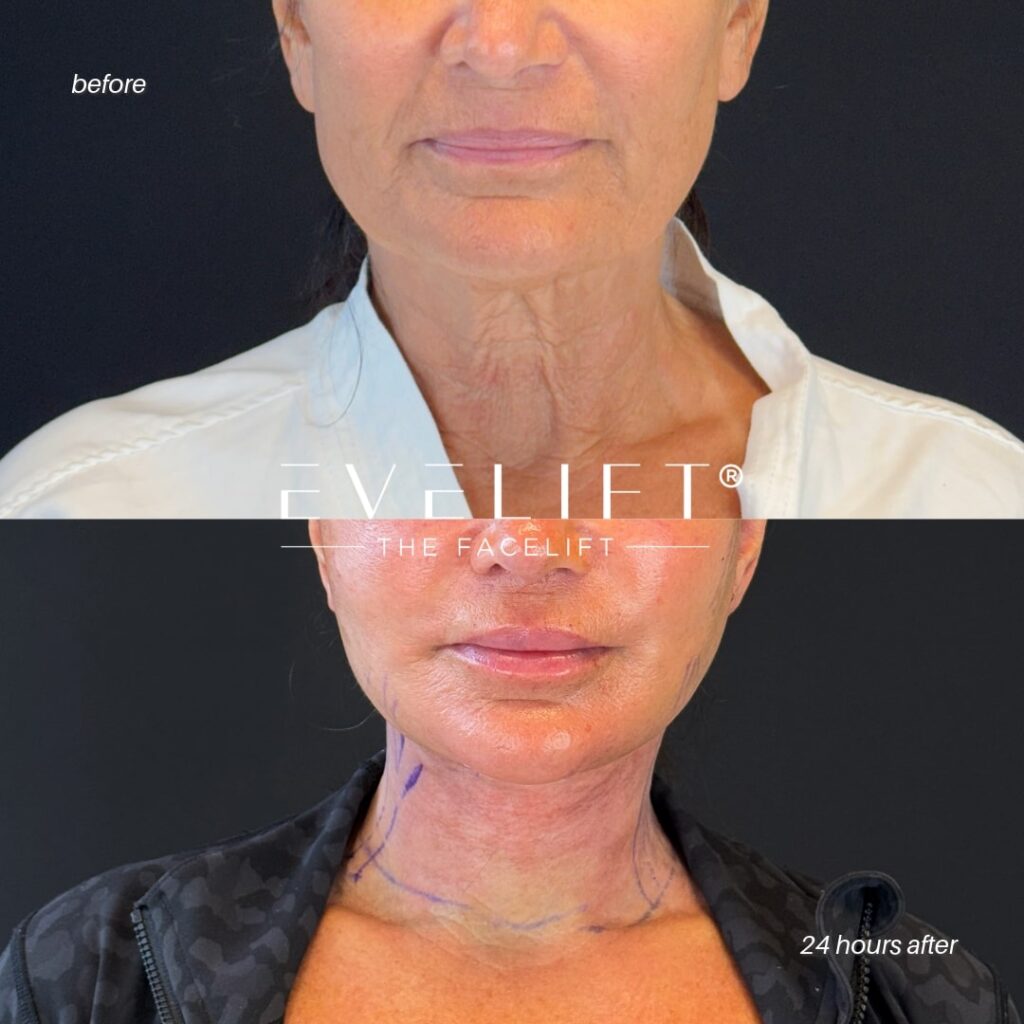 female patient before and after EVELIFT®