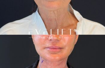 female patient before and after EVELIFT®