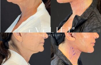 female patient before and after EVELIFT®
