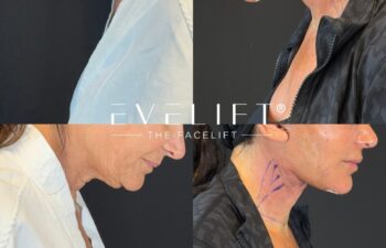 female patient before and after EVELIFT®