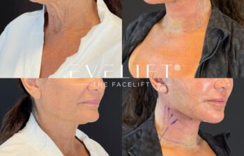 female patient before and after EVELIFT®