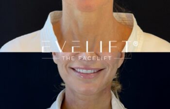 female patient before and after EVELIFT®