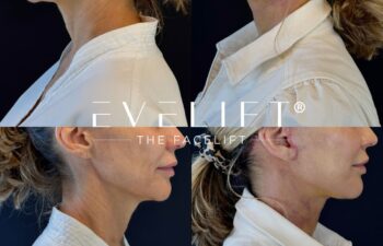 female patient before and after EVELIFT®