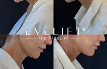 female patient before and after EVELIFT®